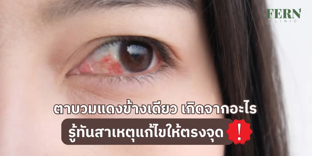 ตาบวมแดงข้างเดียว เกิดจากอะไร รู้ทันสาเหตุแก้ไขให้ตรงจุด