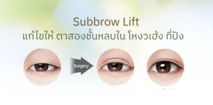 Subbrow Lift แก้ไขให้ ตาสองชั้นหลบใน โหงวเฮ้ง ที่ปัง