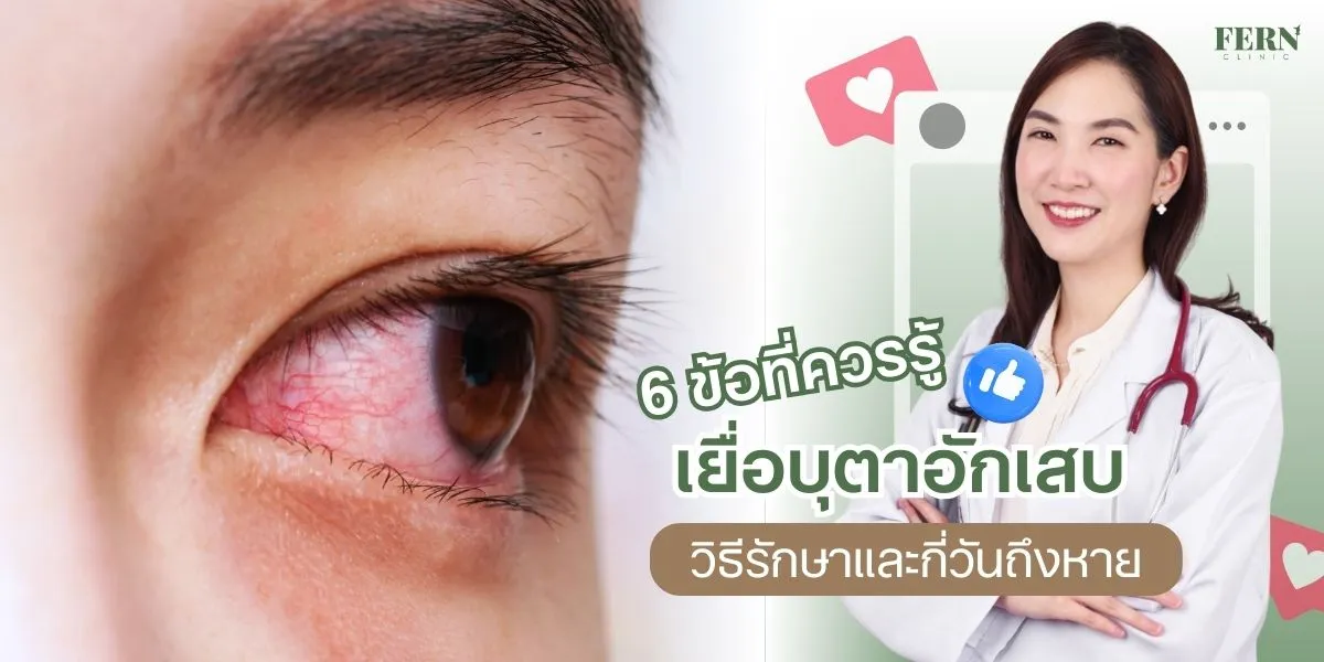 6 ข้อที่ควรรู้ เยื่อบุตาอักเสบ พร้อมวิธีรักษาและกี่วันหาย