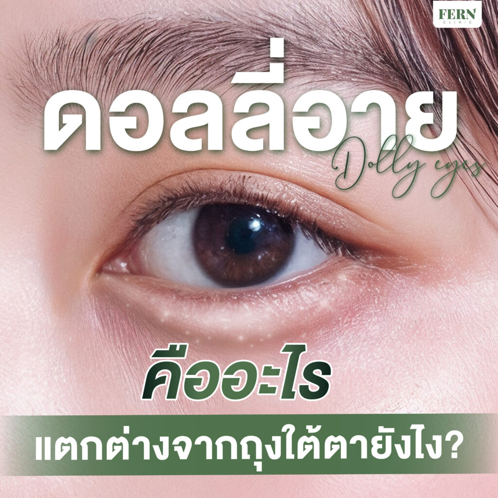 ดอลลี่อาย (dolly eyes) คืออะไร? แตกต่างจากถุงใต้ตายังไง?