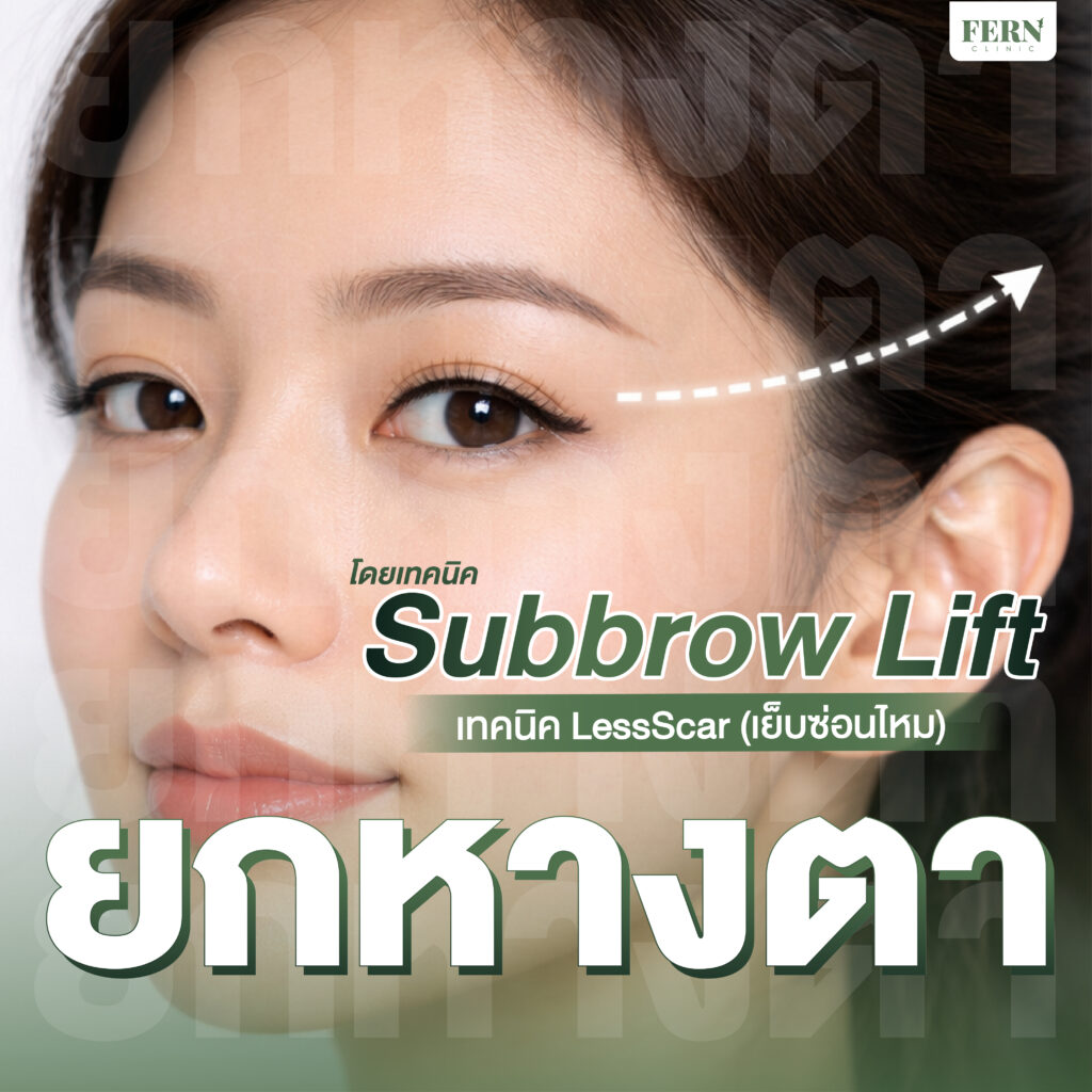 ยกหางตา โดยเทคนิค Subbrow Lift ซ่อนแผลใต้คิ้ว