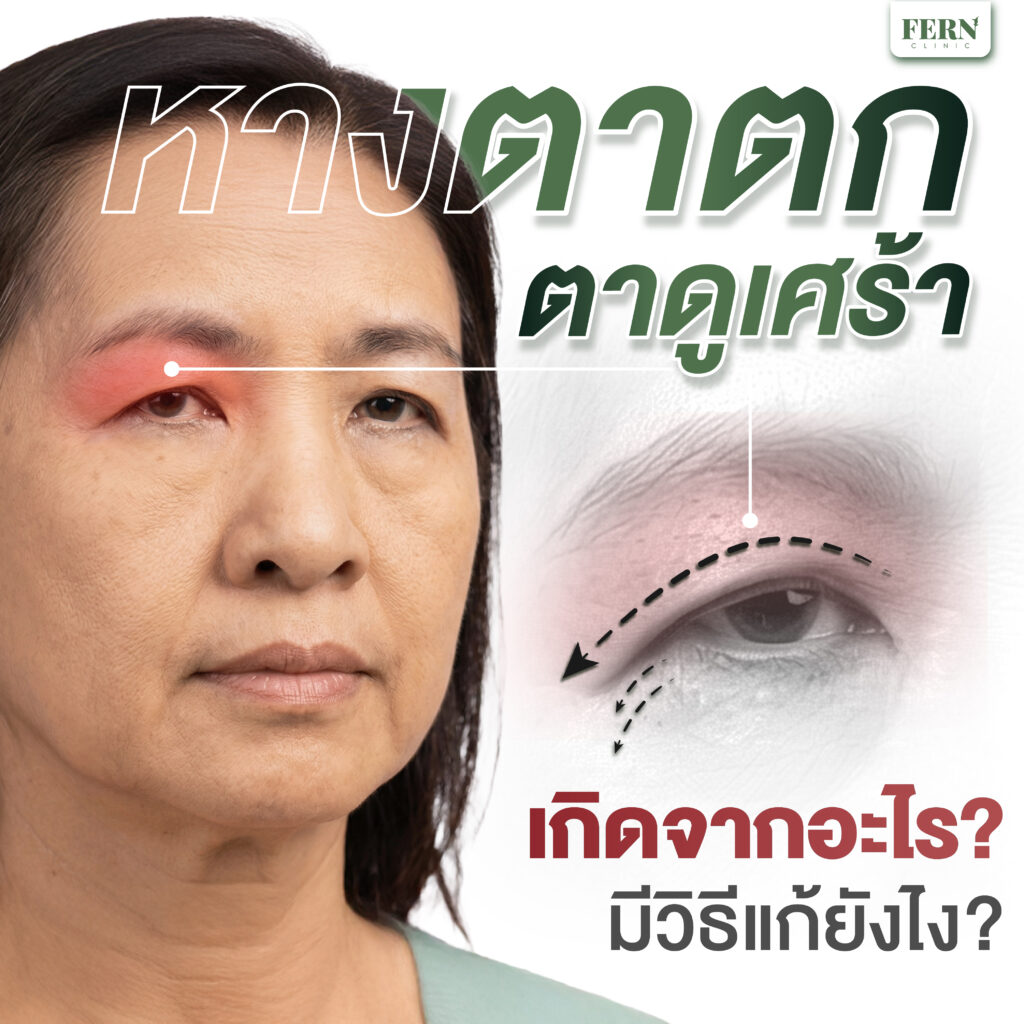 หางตาตก ตาดูเศร้า เกิดจากอะไร มีวิธีแก้ยังไง?