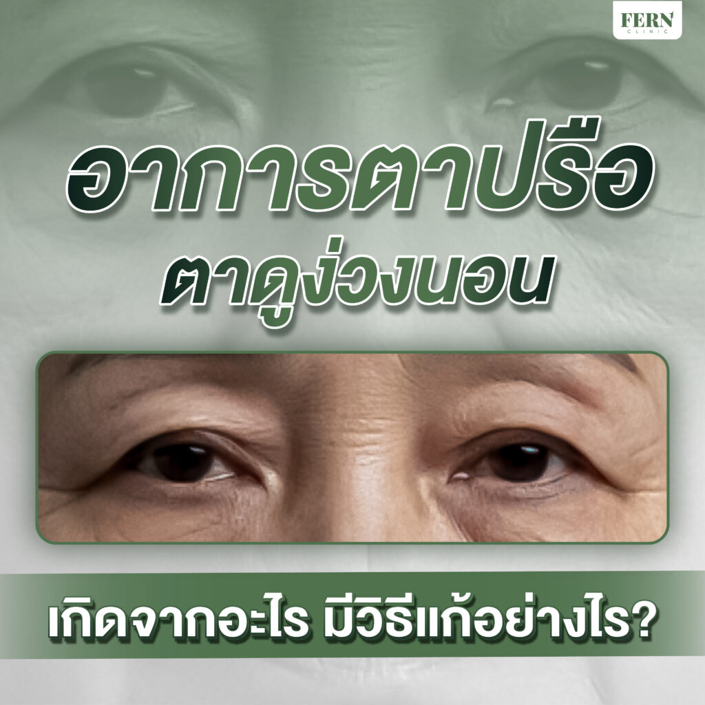 อาการตาปรือ ตาดูง่วงนอน เกิดจากอะไร มีวิธีแก้อย่างไร