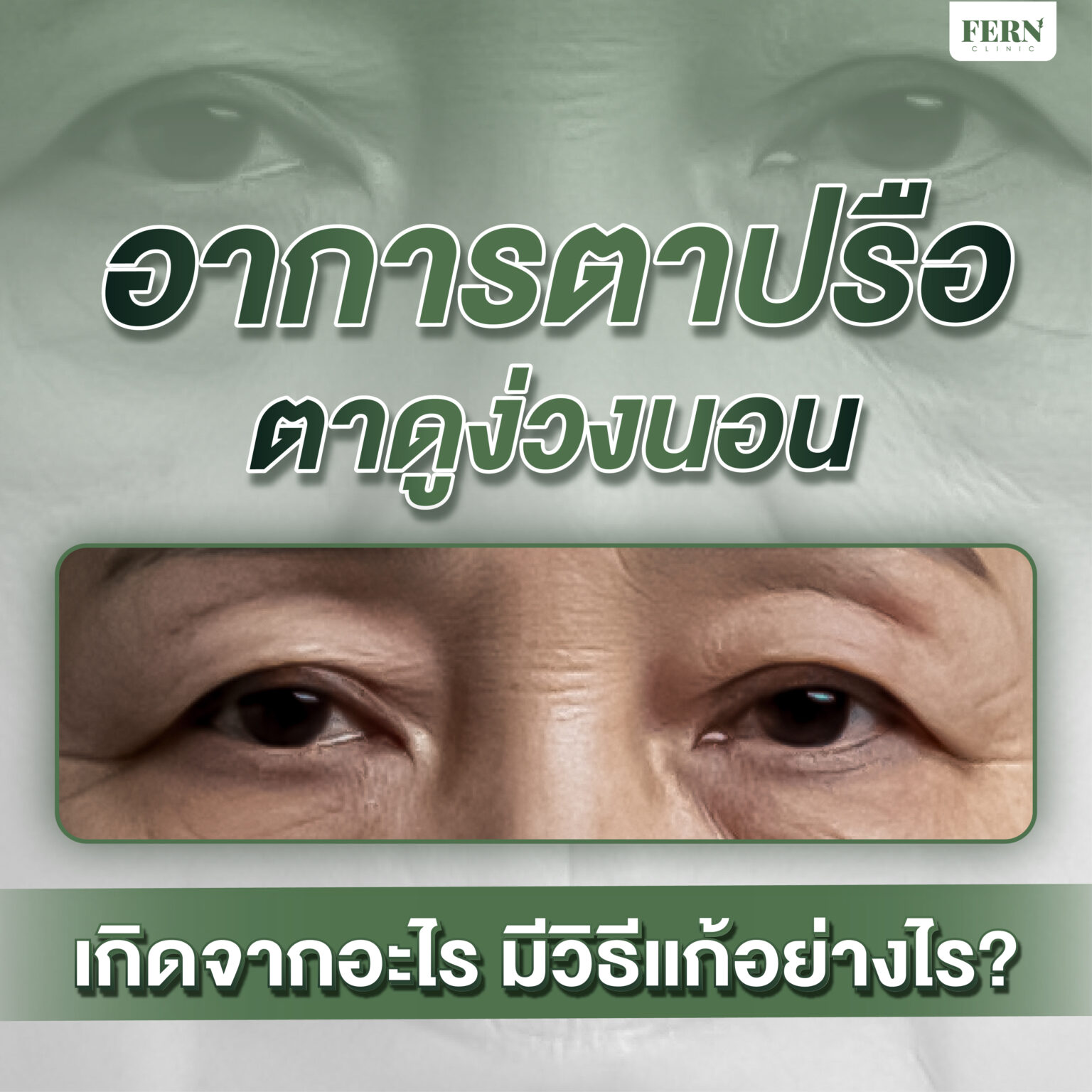 อาการตาปรือ ตาดูง่วงนอน เกิดจากอะไร มีวิธีแก้อย่างไร