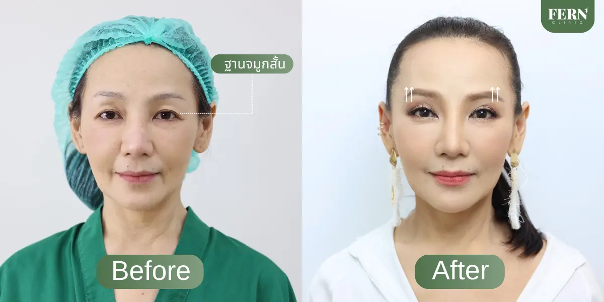 ความรู้สึกก่อนและหลังการทำ subbrow lift