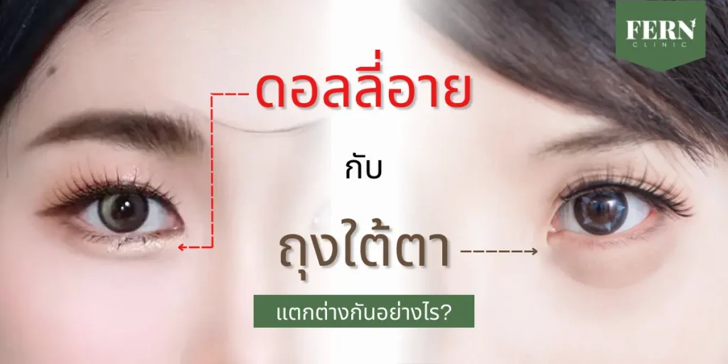 ดอลลี่อาย (dolly eyes) คืออะไร? แตกต่างจากถุงใต้ตายังไง?