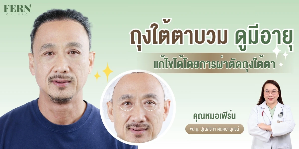รวมวิธีลดถุงใต้ตาแบบธรรมชาติและทางการแพทย์