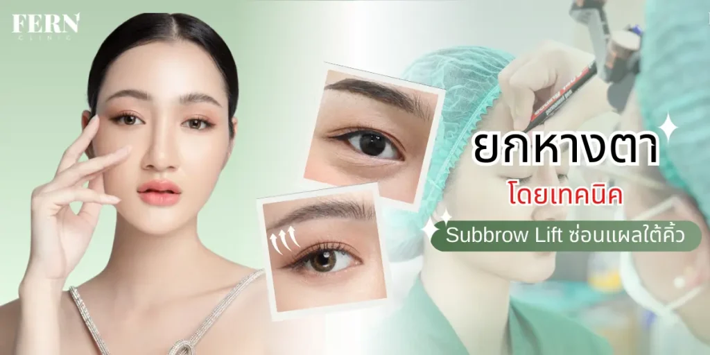 ยกหางตา โดยเทคนิค Subbrow Lift ซ่อนแผลใต้คิ้ว