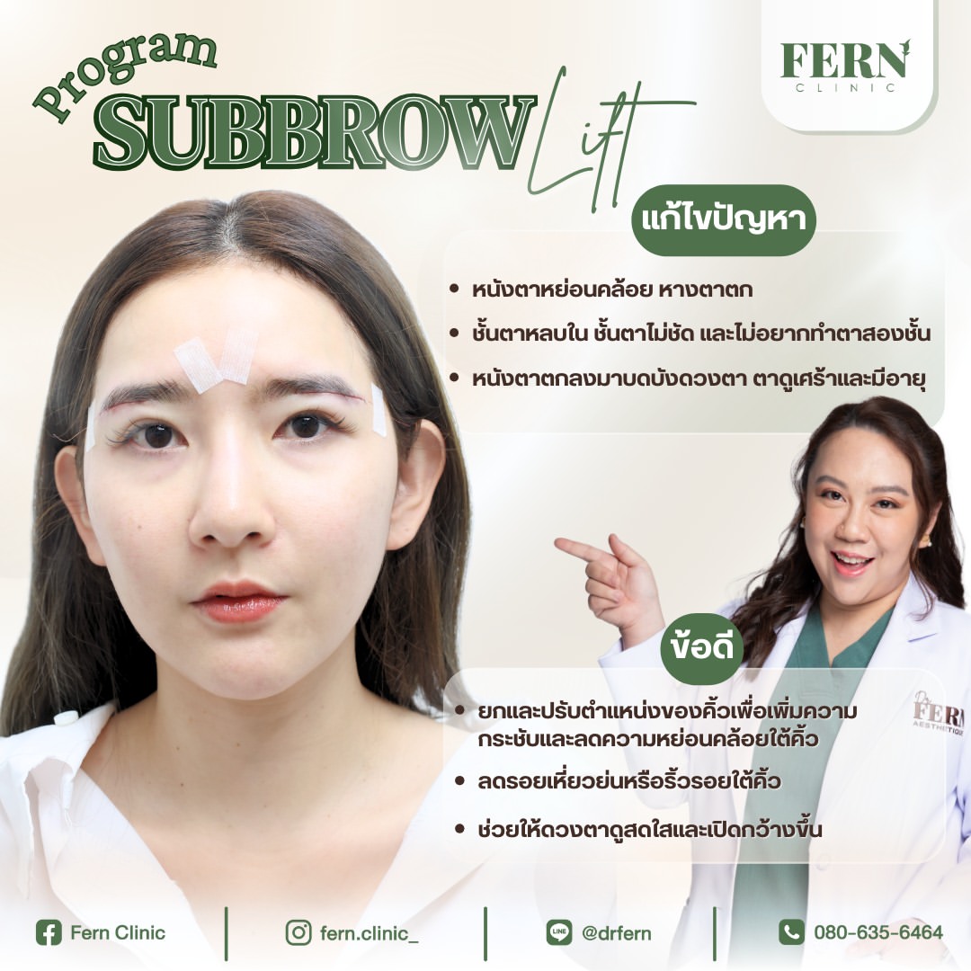 รักษากล้ามเนื้อตาอ่อนแรงด้วย Subbrow Lift 