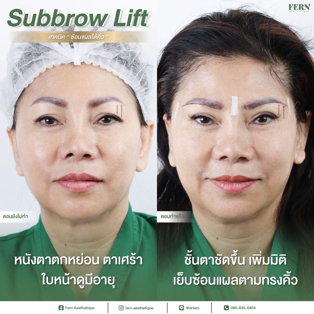 รีวิวการทำ Subbrow Lift ที่ Fern Clinic