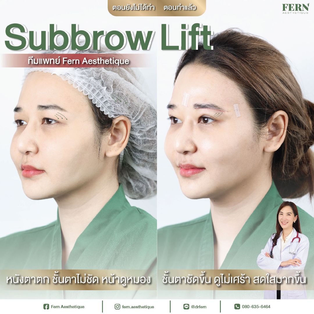 รีวิวการทำ Subbrow Lift ที่ Fern Clinic