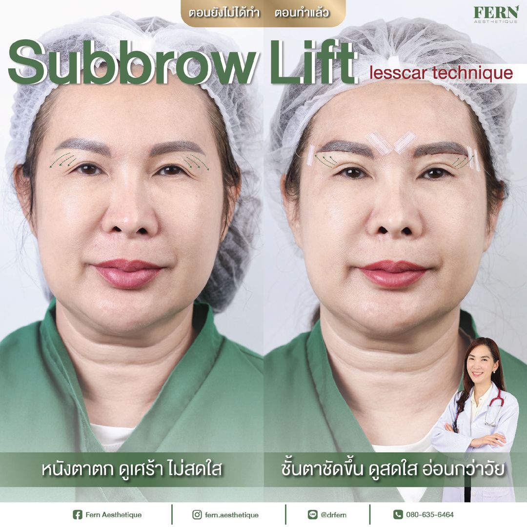 รีวิวการทำ Subbrow Lift ที่ Fern Clinic