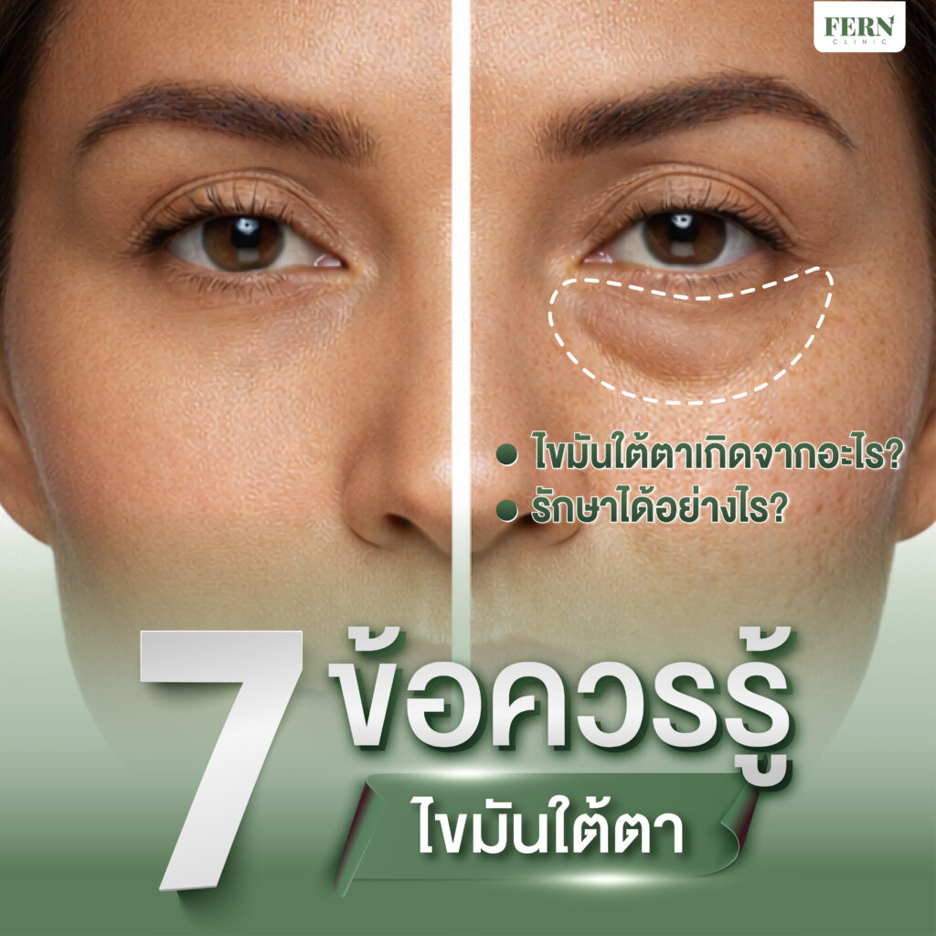 7 ข้อควรรู้ ไขมันใต้ตาเกิดจากอะไร รักษาได้อย่างไร?