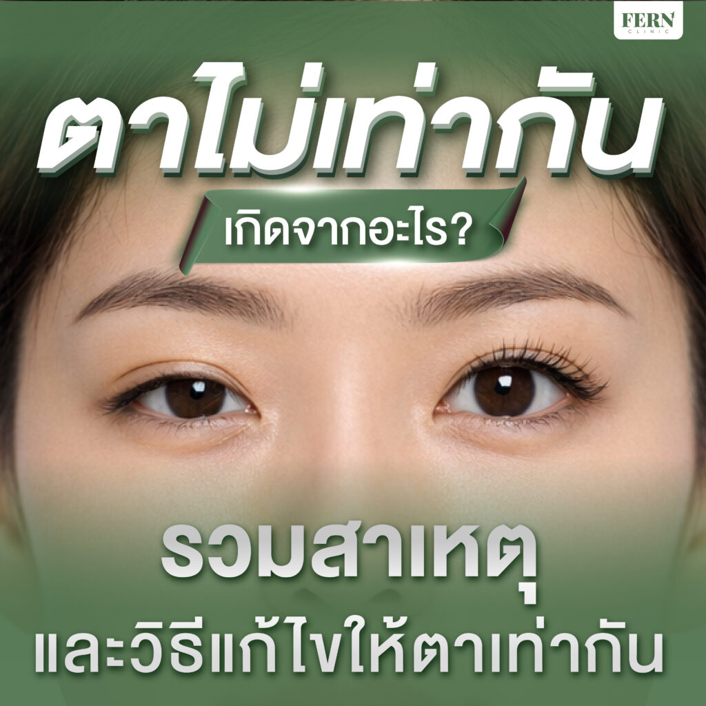 ตาไม่เท่ากัน เกิดจากอะไร? รวมสาเหตุและวิธีแก้ไขให้ตาเท่ากัน