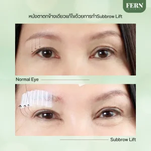 ทำไมต้องทำตาที่ Fern Clinic?