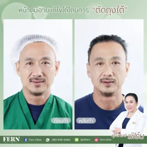 ทำไมต้องผ่าตัดไขมันใต้ตากับ Fern Clinic?