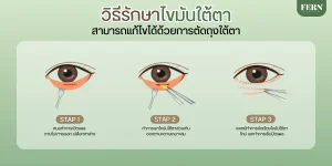 ถุงไขมันใต้ตารักษาได้อย่างไร?