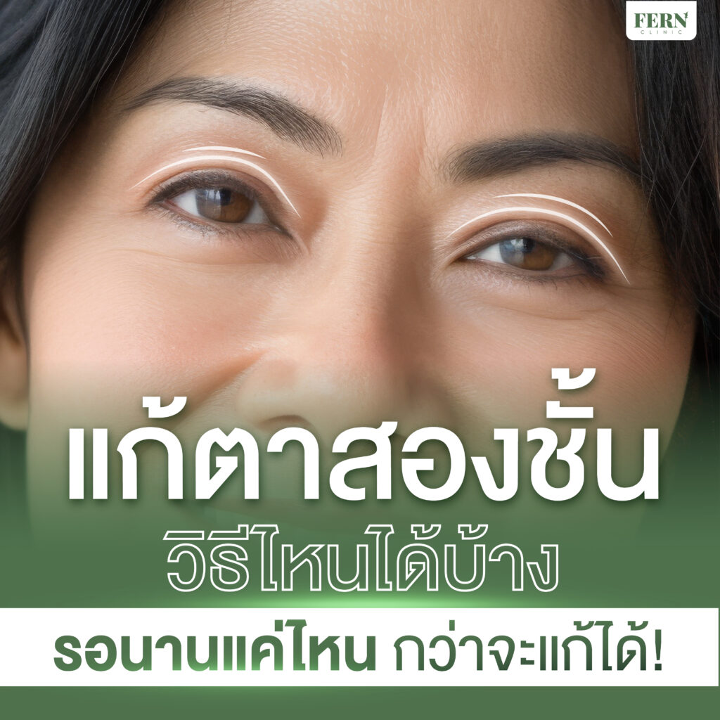 แก้ตาสองชั้น วิธีไหนได้บ้าง รอนานแค่ไหนกว่าจะแก้ได้