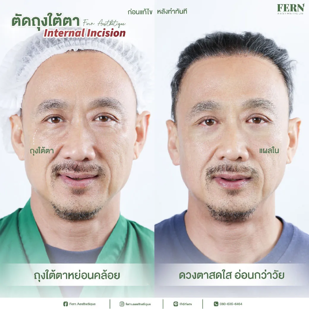 รีวิวผ่าตัดถุงใต้ตา Fern Clinic