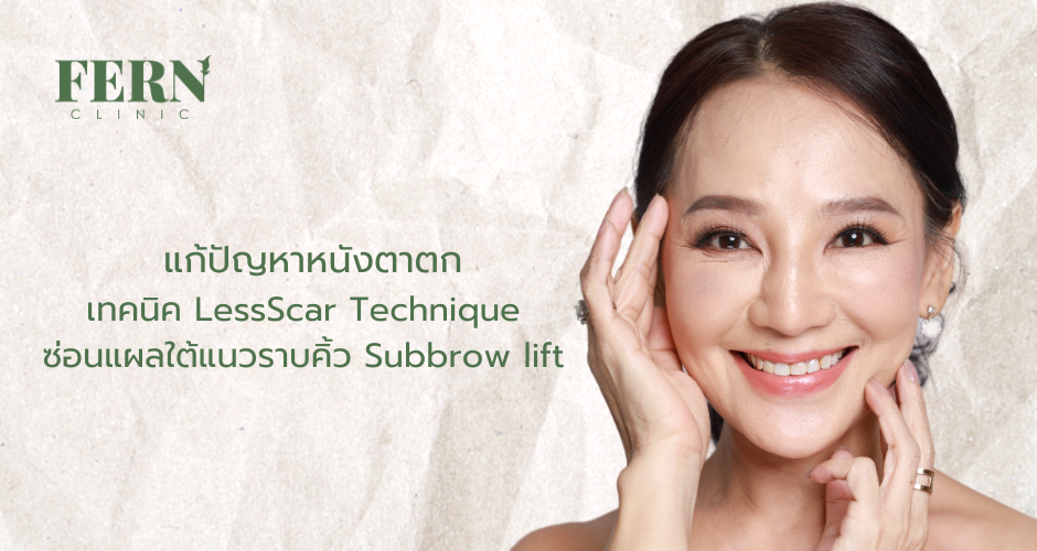 Subbrow lift