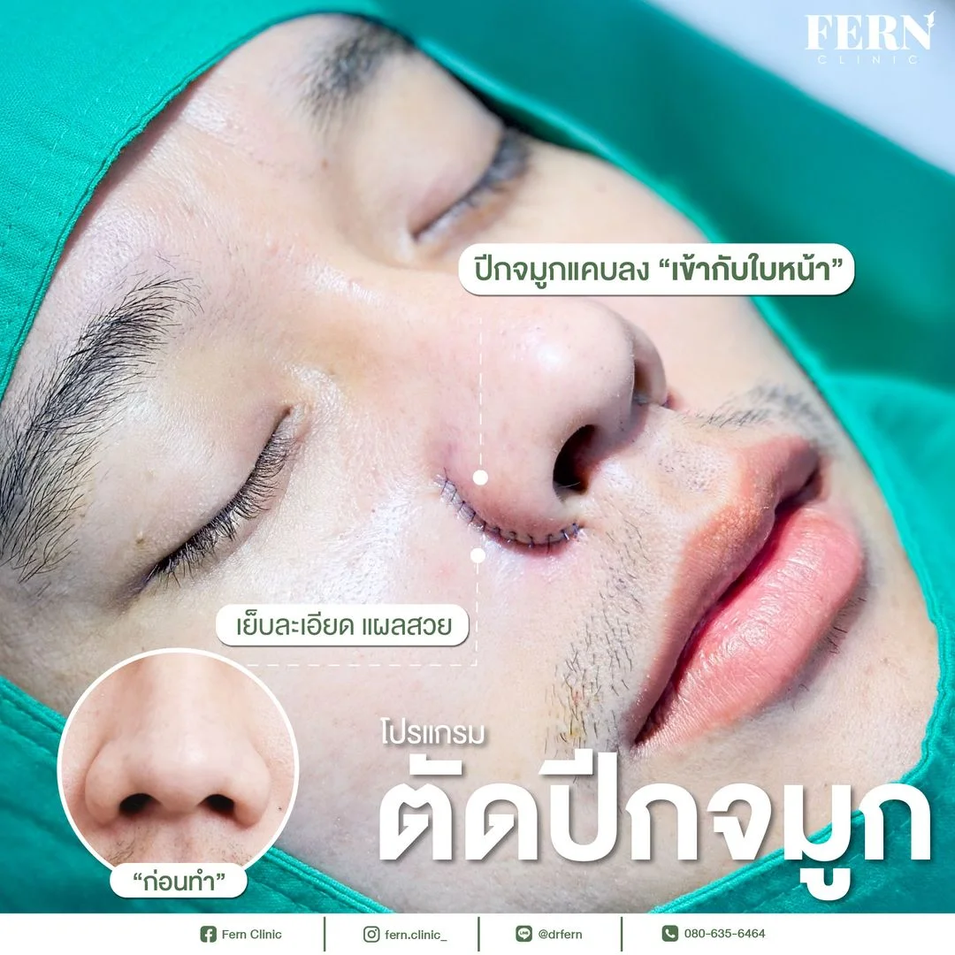 รีวิว ตัดปีกจมูก Fern Clinic