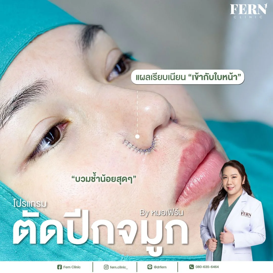 รีวิว ตัดปีกจมูก Fern Clinic