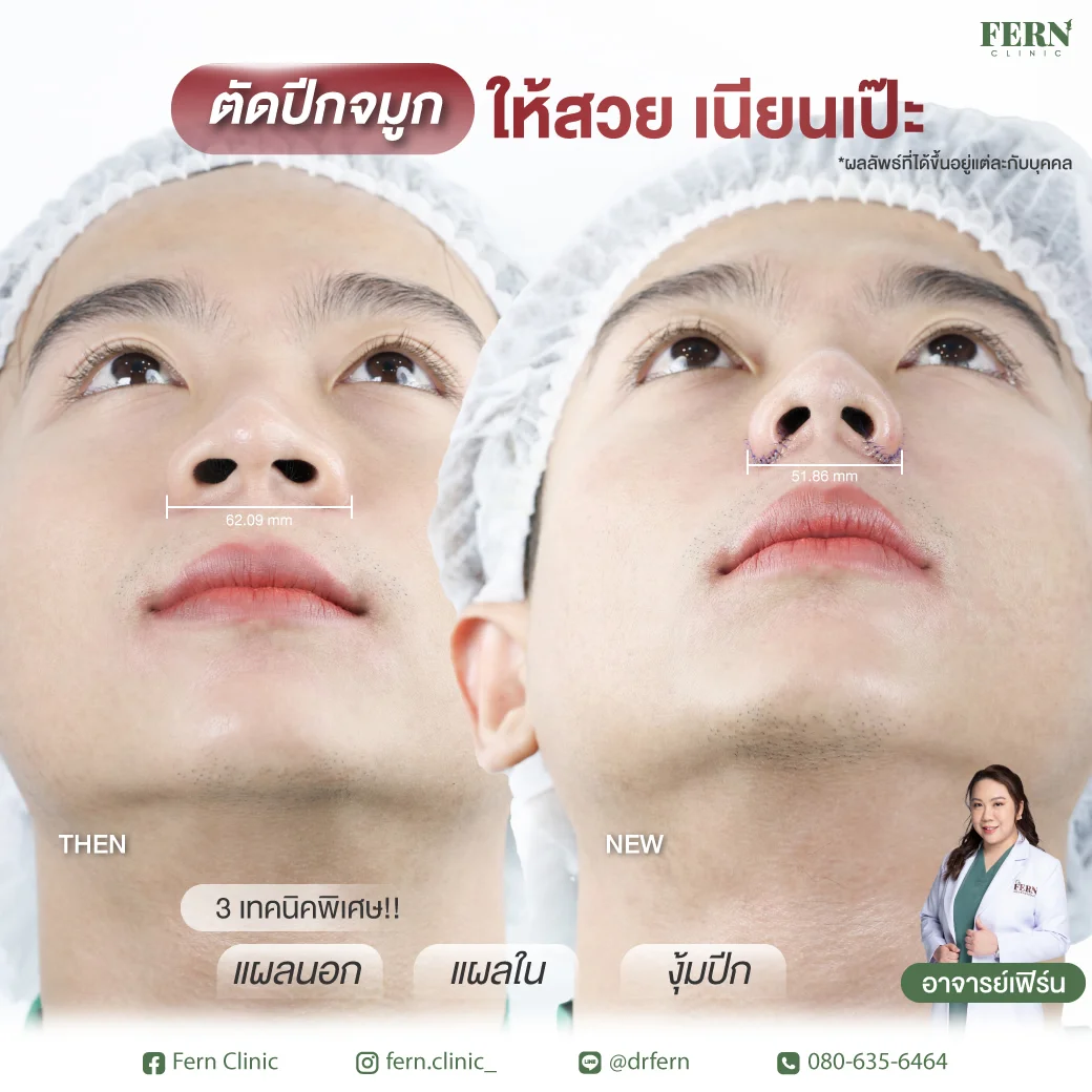 รีวิว ตัดปีกจมูก Fern Clinic