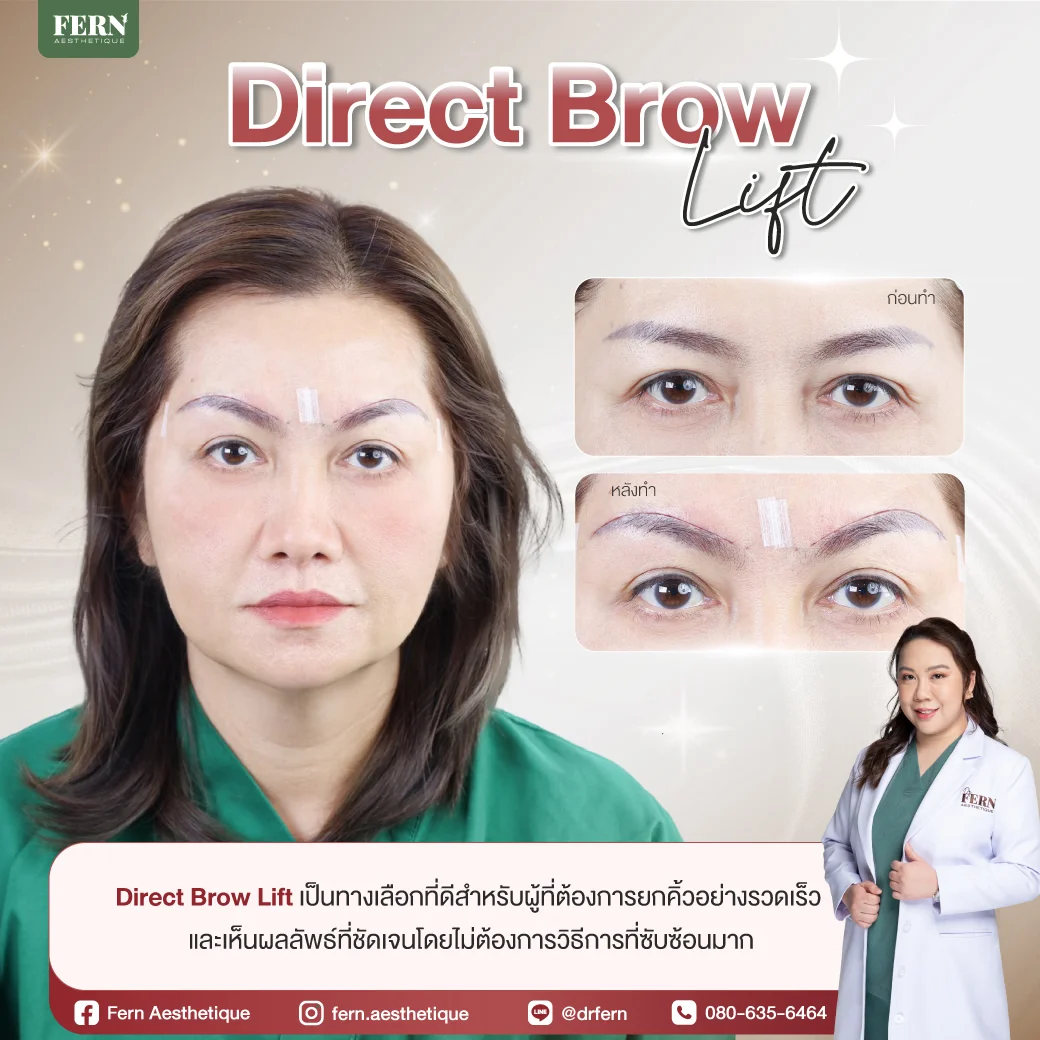 ศัลยกรรมยกคิ้ว ด้วยเทคนิค Direct Brow lift ที่ Fern Clinic