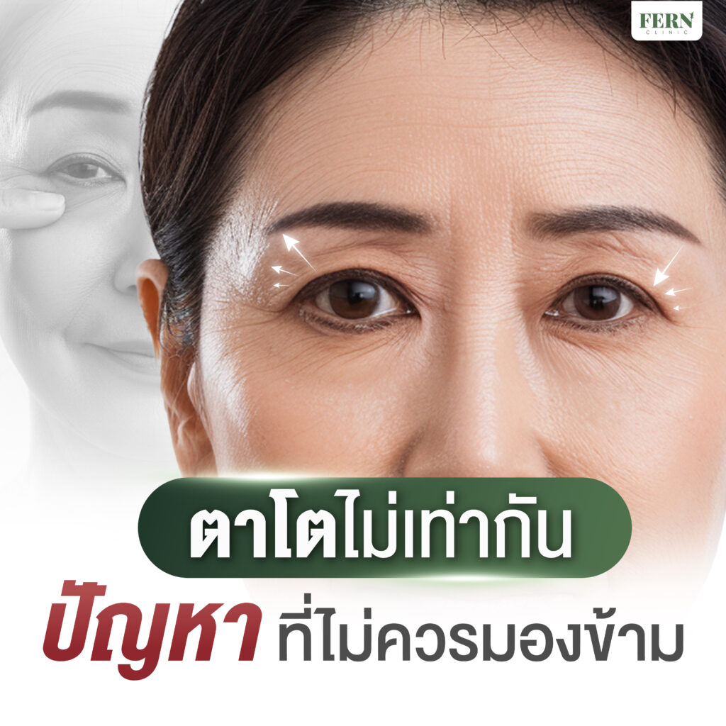 ตาโตไม่เท่ากัน ปัญหาที่ไม่ควรมองข้าม