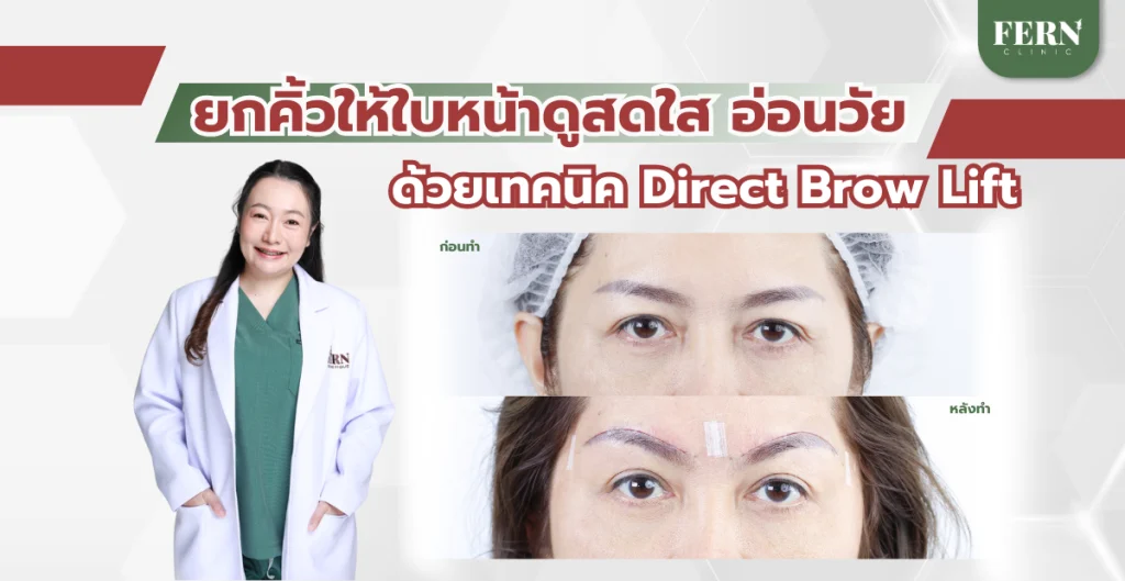 ยกคิ้วให้ใบหน้าดูสดใส อ่อนวัย ด้วยเทคนิค Direct Brow Lift