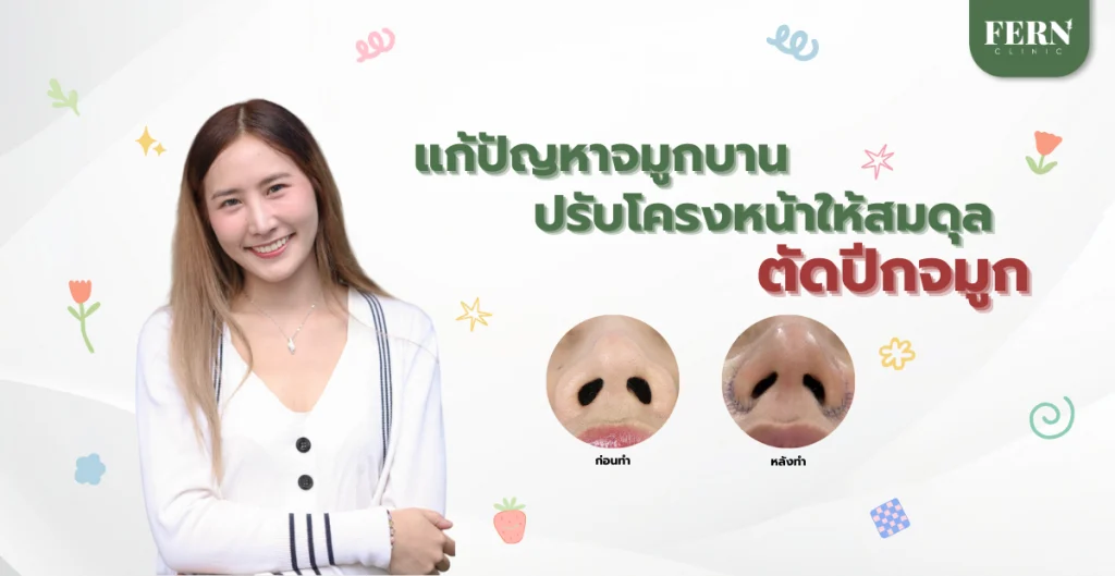 ตัดปีกจมูก แก้ปัญหาจมูกบาน ปรับโครงหน้าให้สมดุล