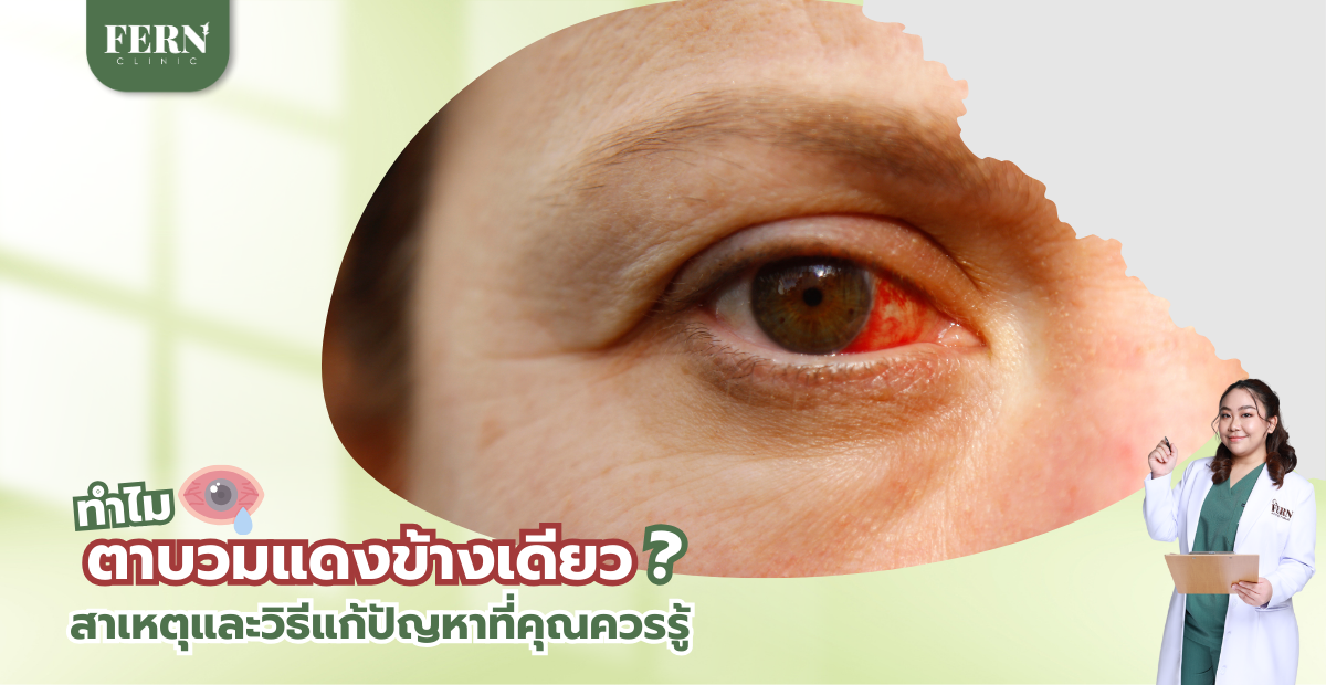 ทำไมตาบวมแดงข้างเดียว? สาเหตุและวิธีแก้ปัญหาที่คุณควรรู้