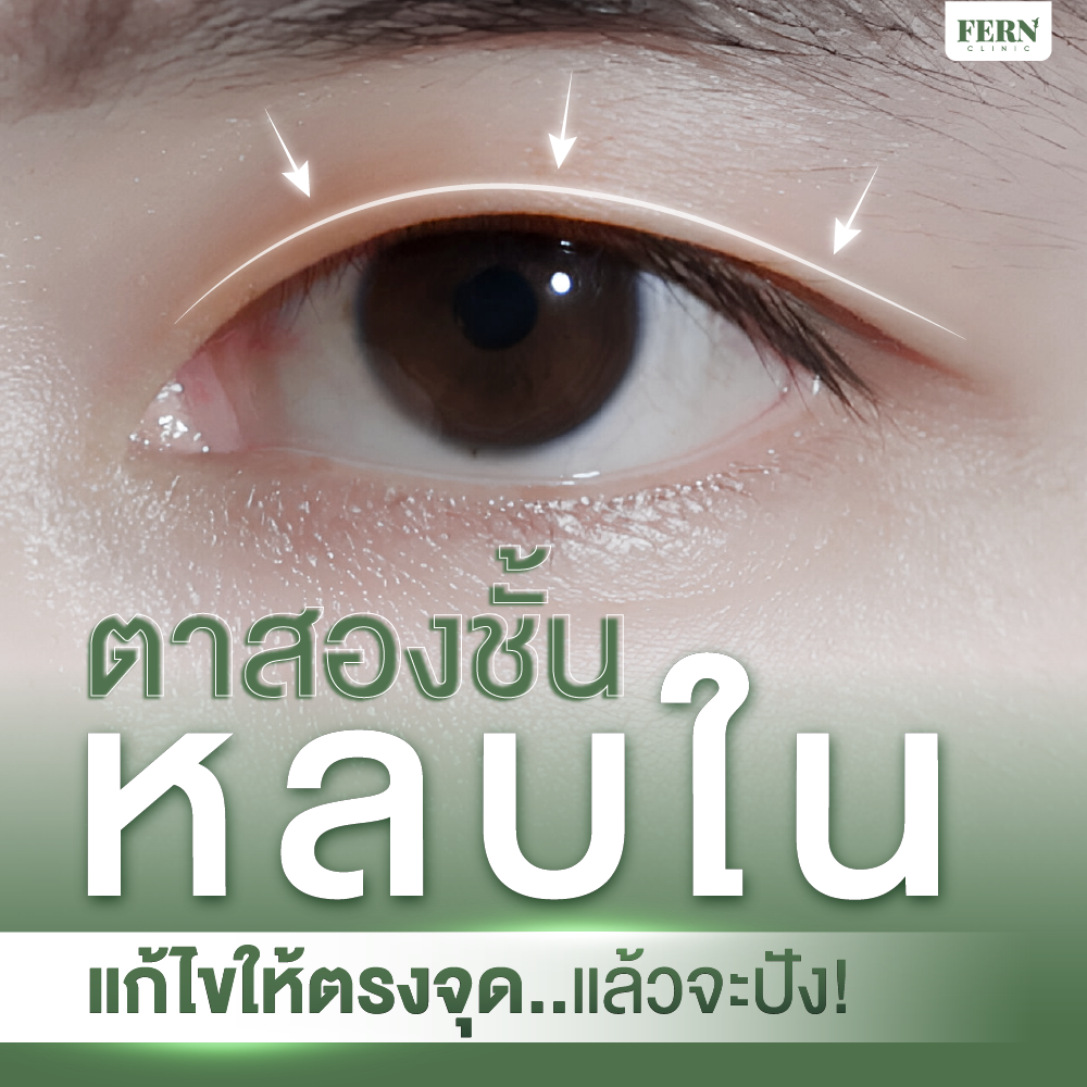 ตาสองชั้นหลบใน เกิดจากอะไร แก้ไขให้ตรงจุดแล้วจะปัง
