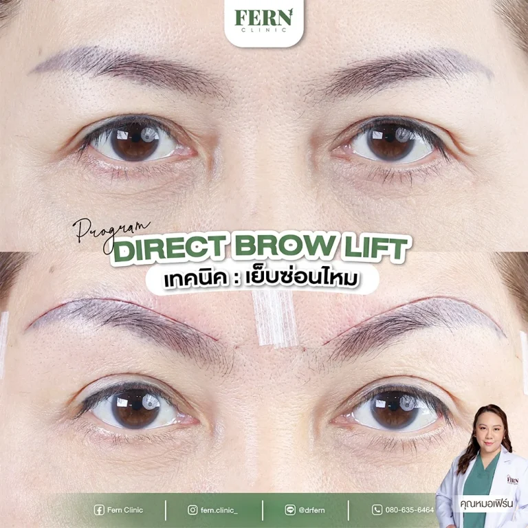 รีวิว ผ่าตัดยกคิ้ว ที่ Fern Clinic