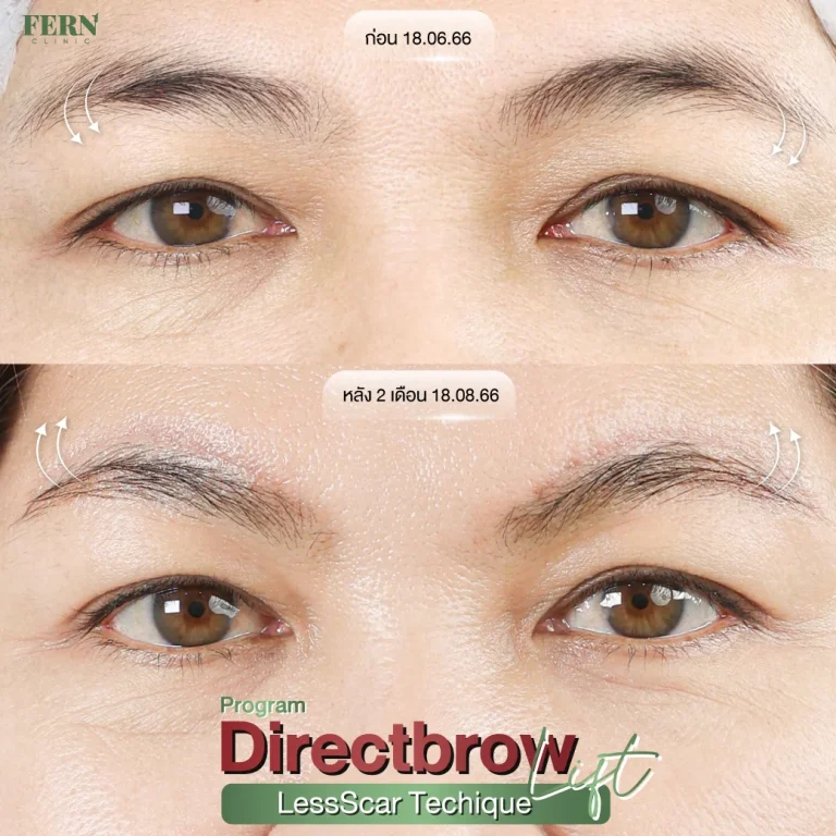 รีวิว ผ่าตัดยกคิ้ว ที่ Fern Clinic