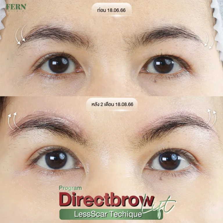 รีวิว ผ่าตัดยกคิ้ว ที่ Fern Clinic