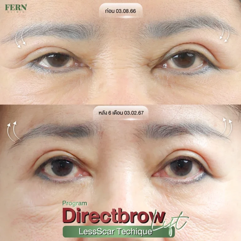 รีวิว ผ่าตัดยกคิ้ว ที่ Fern Clinic