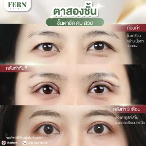 รีวิวทำตาสองชั้น Fern Clinic