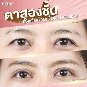 รีวิวทำตาสองชั้น Fern Clinic