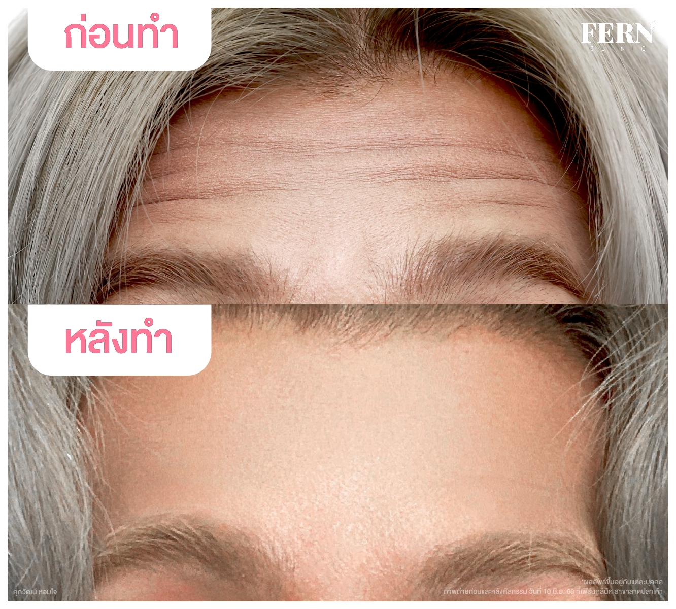 LINE_ALBUM_รีวิว Botox_250927_1