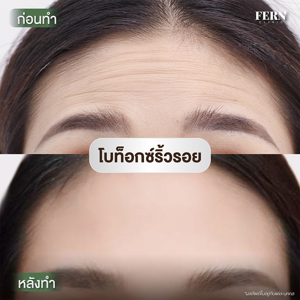 LINE_ALBUM_รีวิว Botox_250927_5