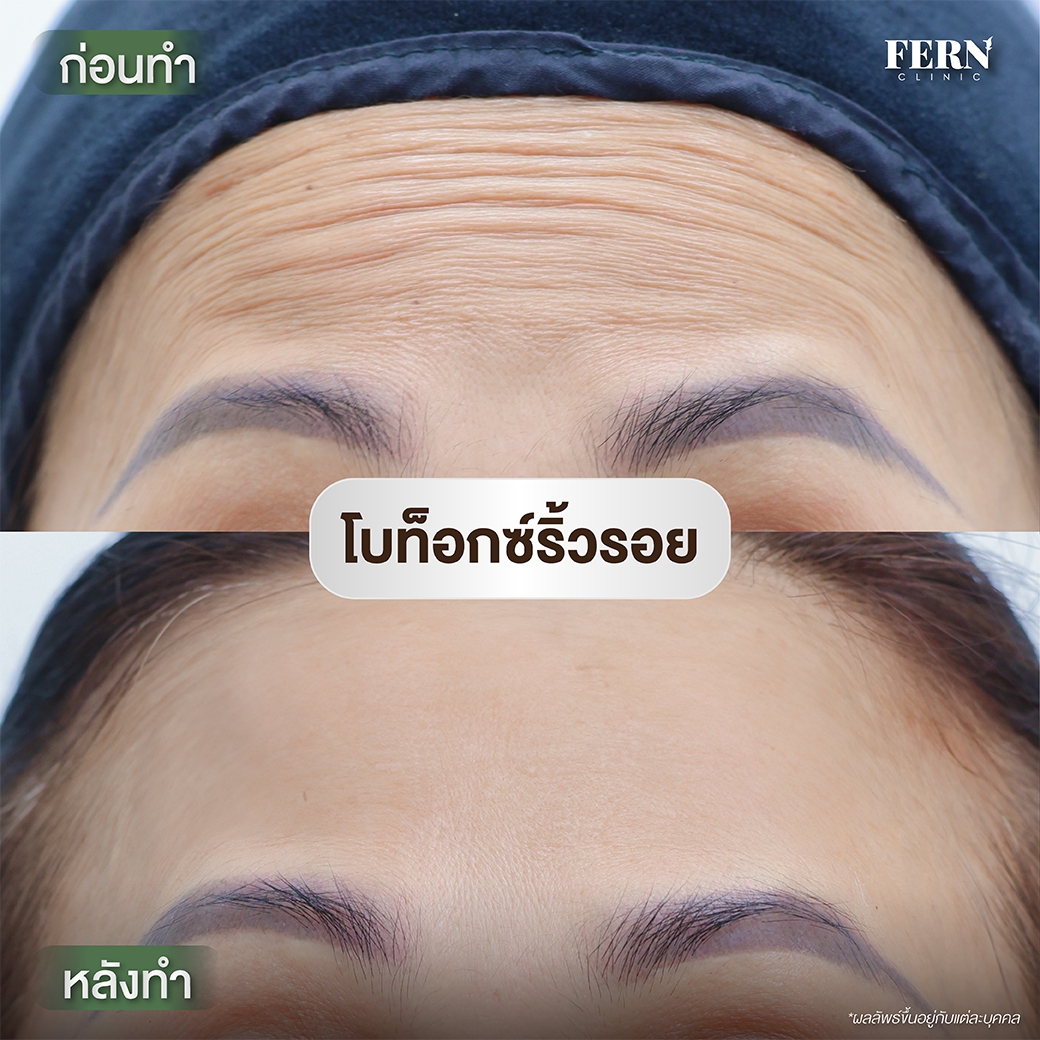 LINE_ALBUM_รีวิว Botox_250927_6