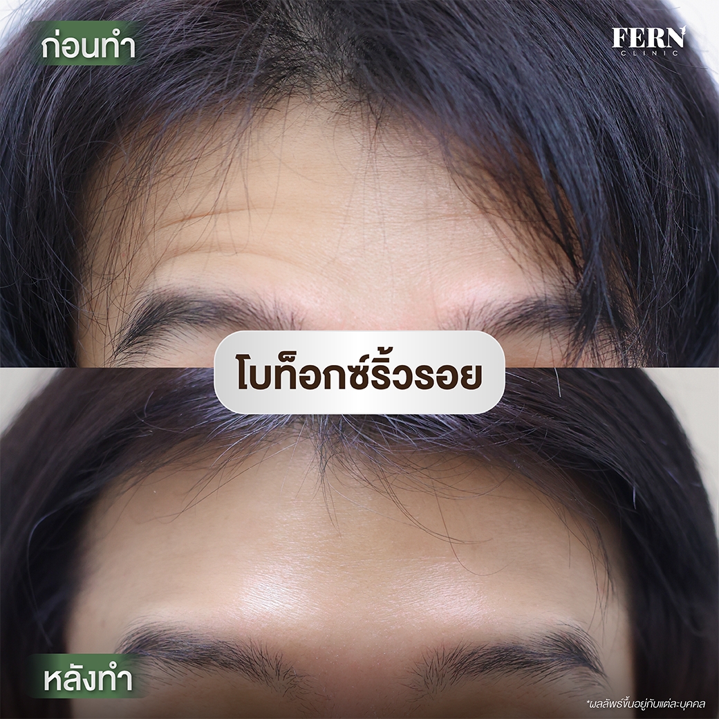 LINE_ALBUM_รีวิว Botox_250927_7