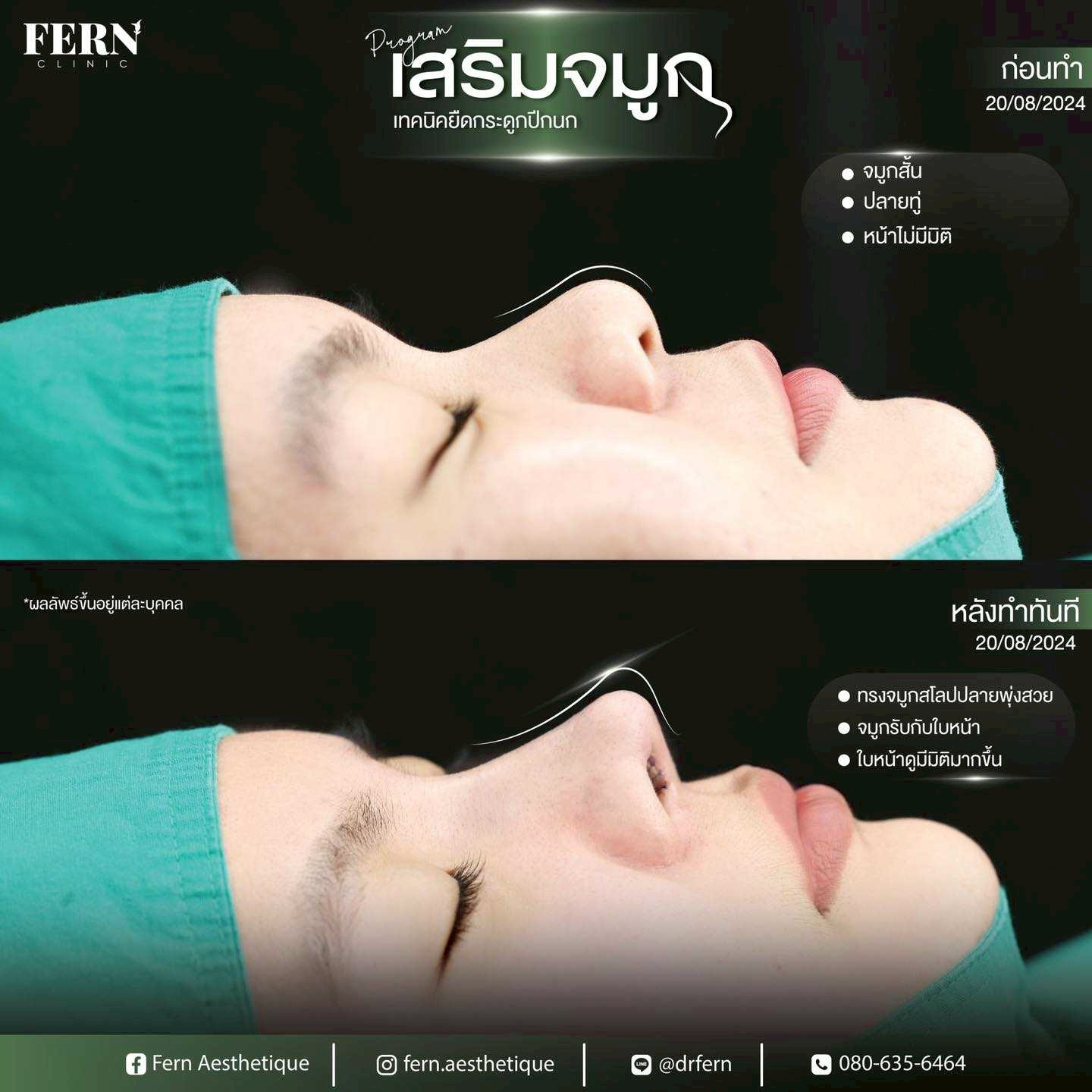 LINE_ALBUM_รีวิวเสริมจมูก_250927_20