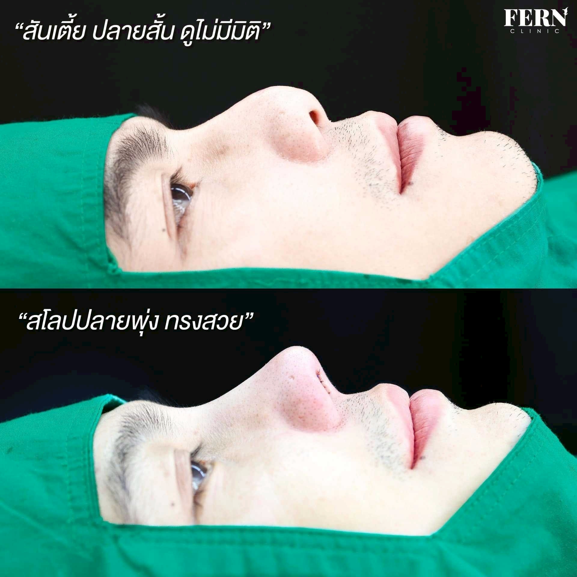 LINE_ALBUM_รีวิวเสริมจมูก_250927_30