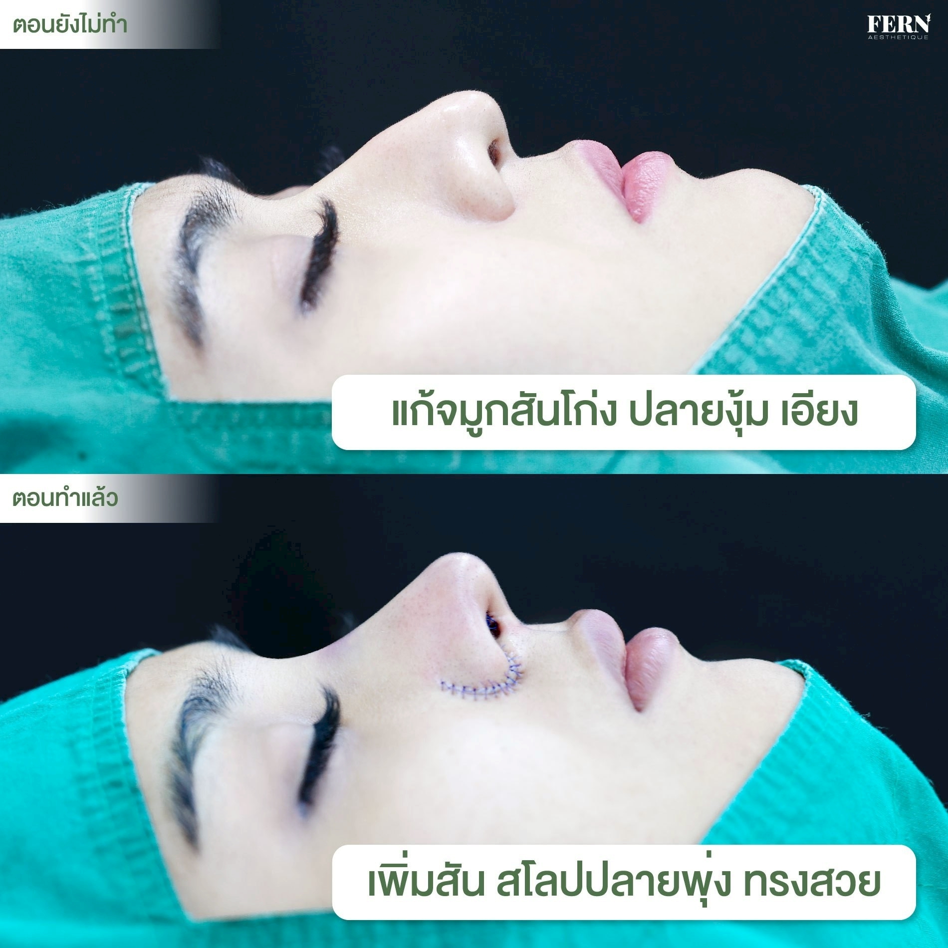 LINE_ALBUM_รีวิวเสริมจมูก_250927_34