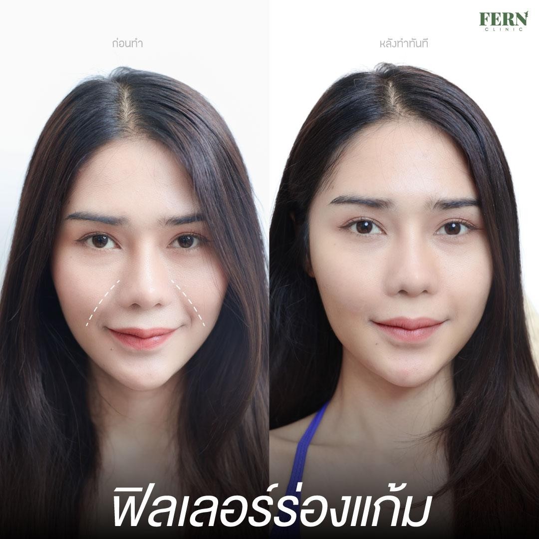 LINE_ALBUM_เคสรีวิว FILLER_250927_1