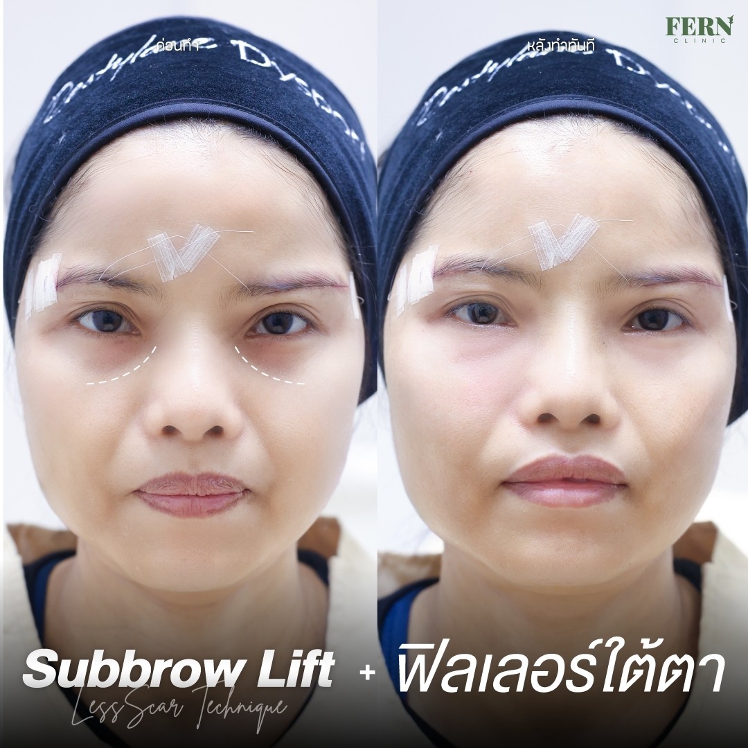 LINE_ALBUM_เคสรีวิว FILLER_250927_10