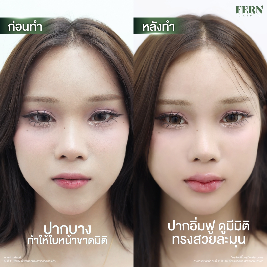 LINE_ALBUM_เคสรีวิว FILLER_250927_12