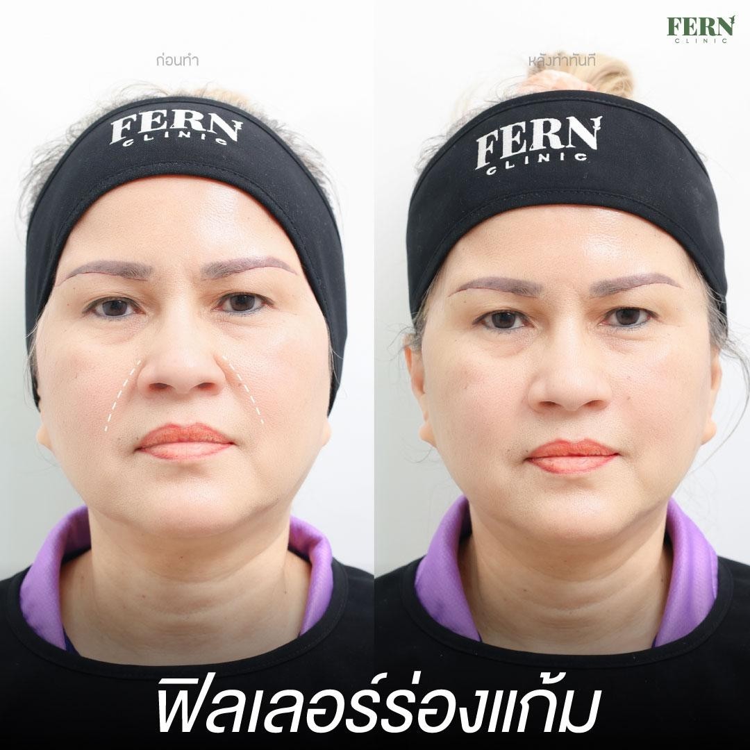 LINE_ALBUM_เคสรีวิว FILLER_250927_2